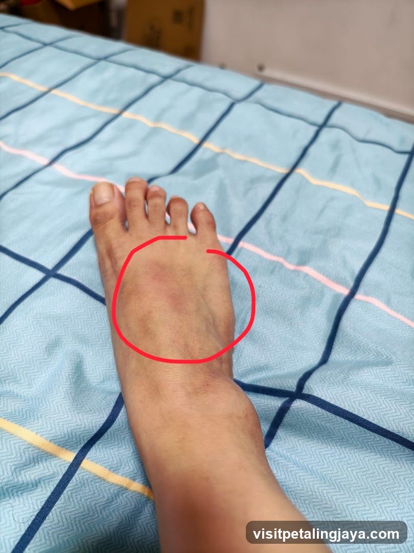 Bruised Foot
