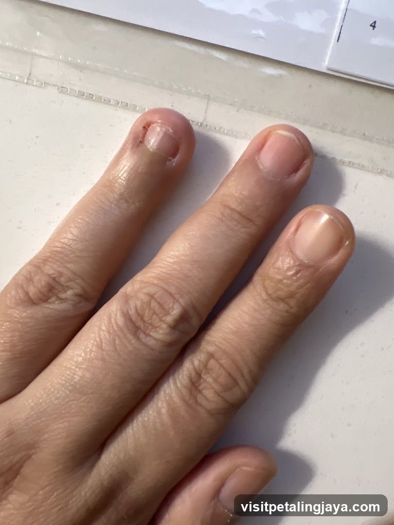 Fingers with bitten nails