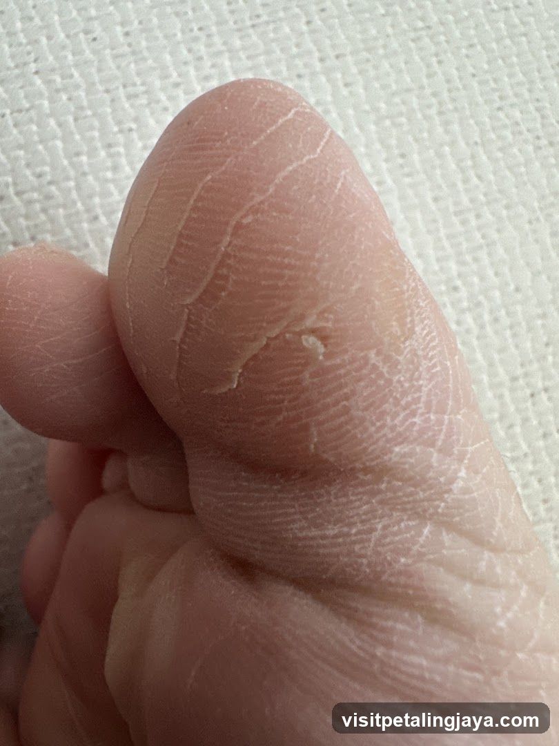 Close-up of Dry, Cracked Skin on a Foot