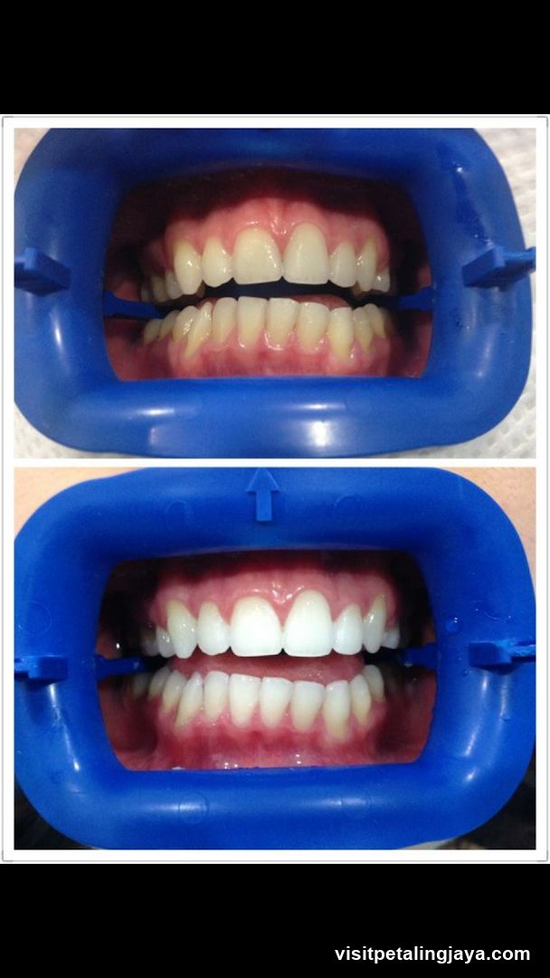 Dental Treatment Before and After
