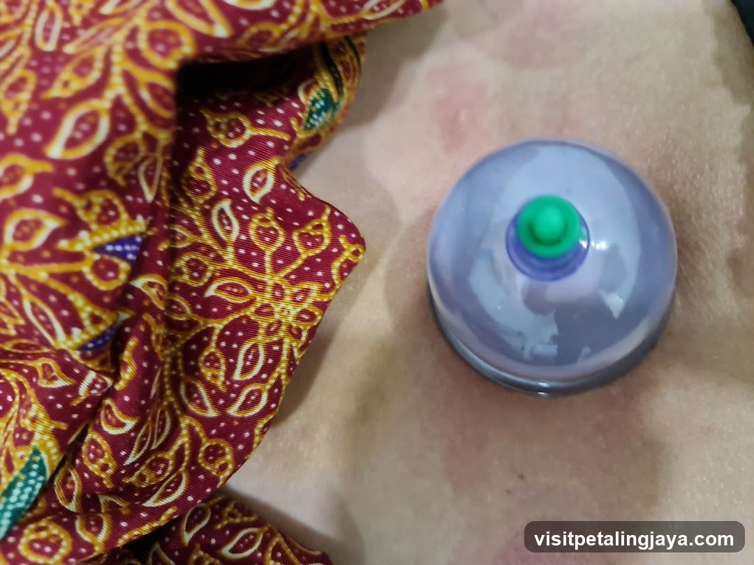 Cupping Therapy on Skin