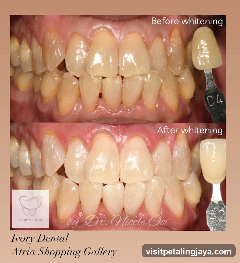 Dental Whitening Before and After