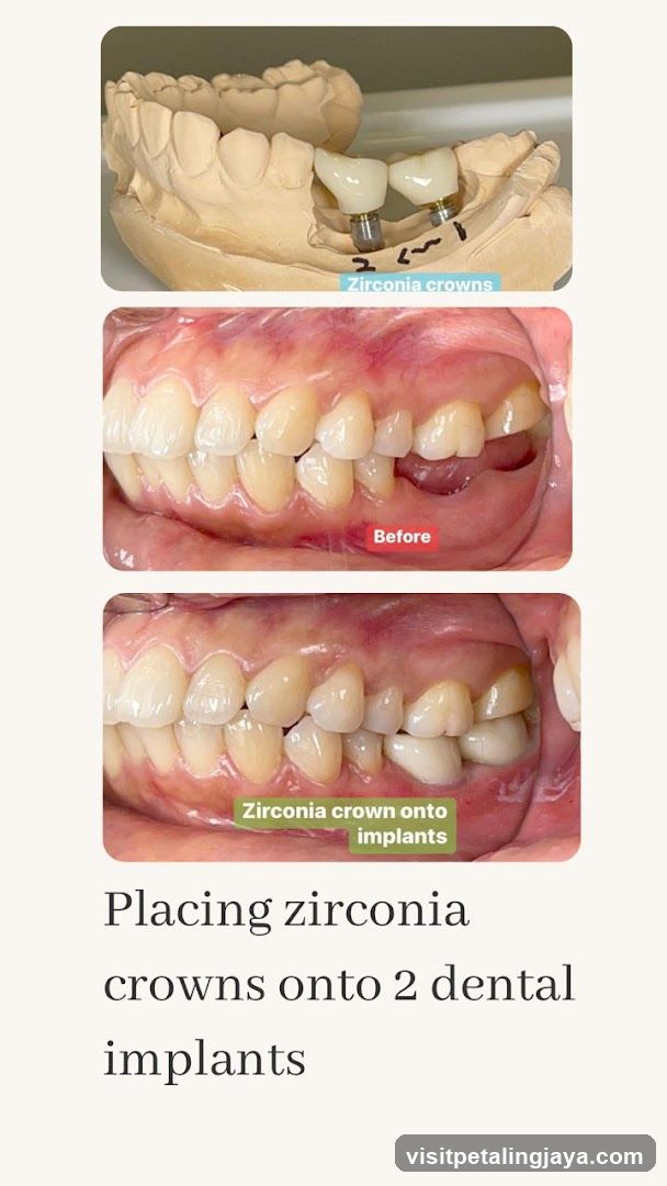 Placing zirconia crowns onto 2 dental implants