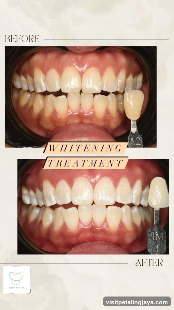Teeth Whitening Treatment Before and After