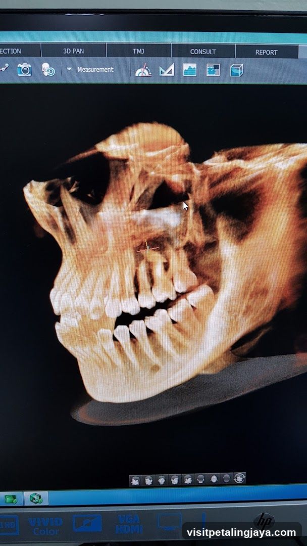 3D CT Scan of Skull