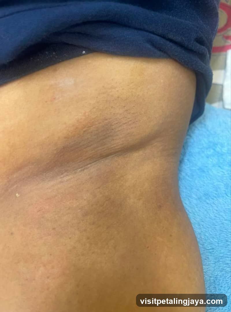 Skin Condition on Abdomen