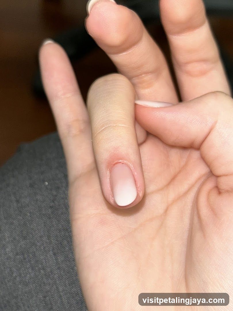 Hand with swollen finger