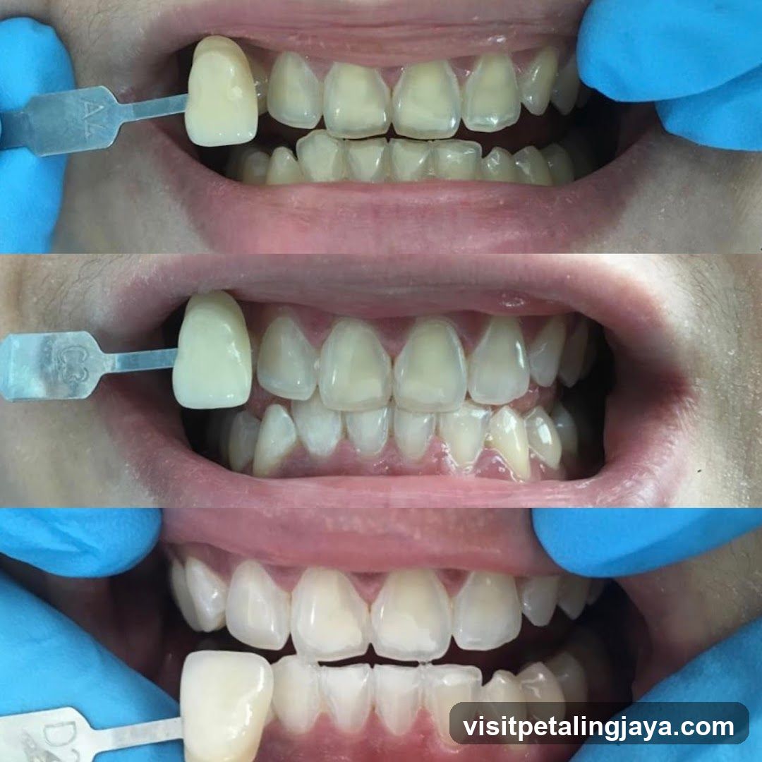 Dental Shade Selection
