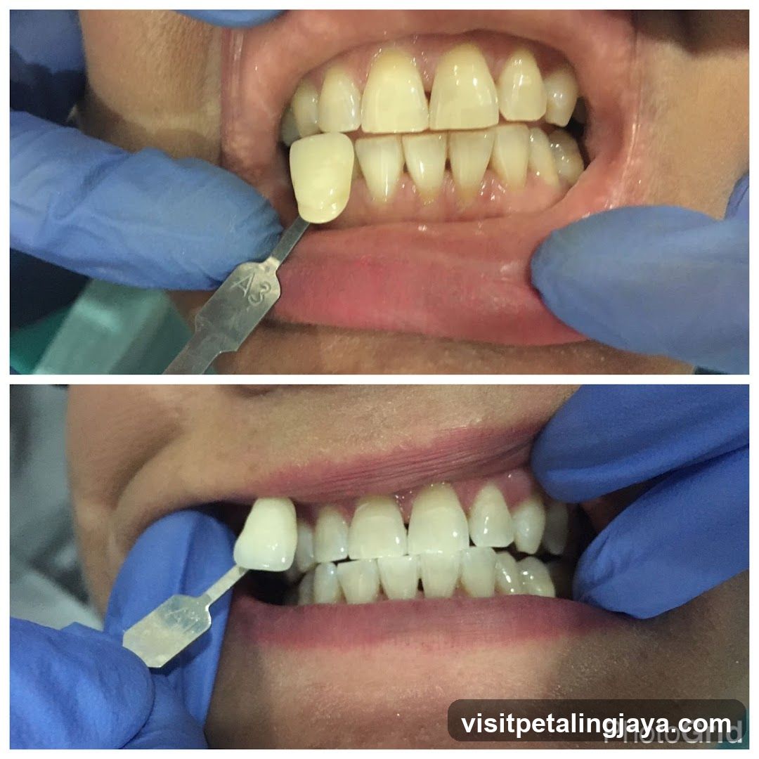 Dental Shade Selection