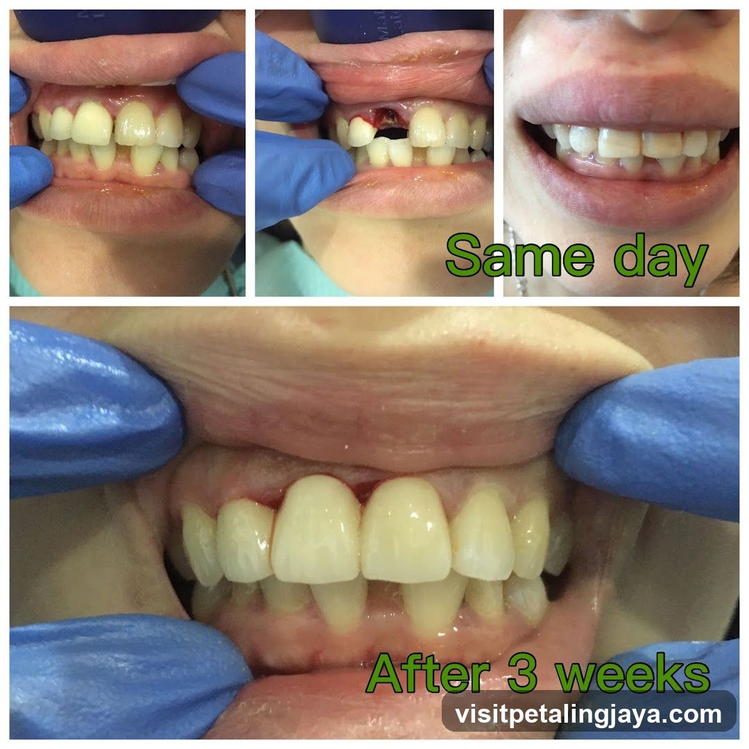 Dental Treatment Before and After