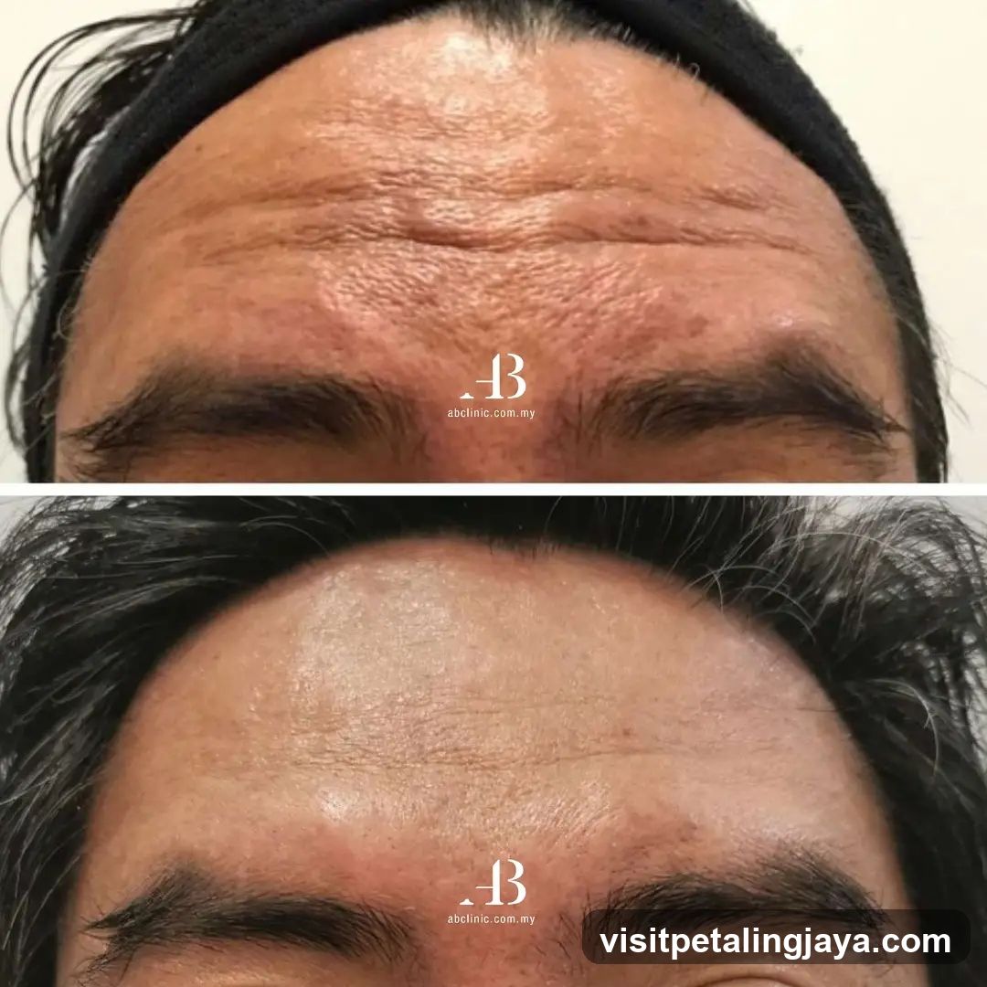 Forehead skin comparison before and after treatment