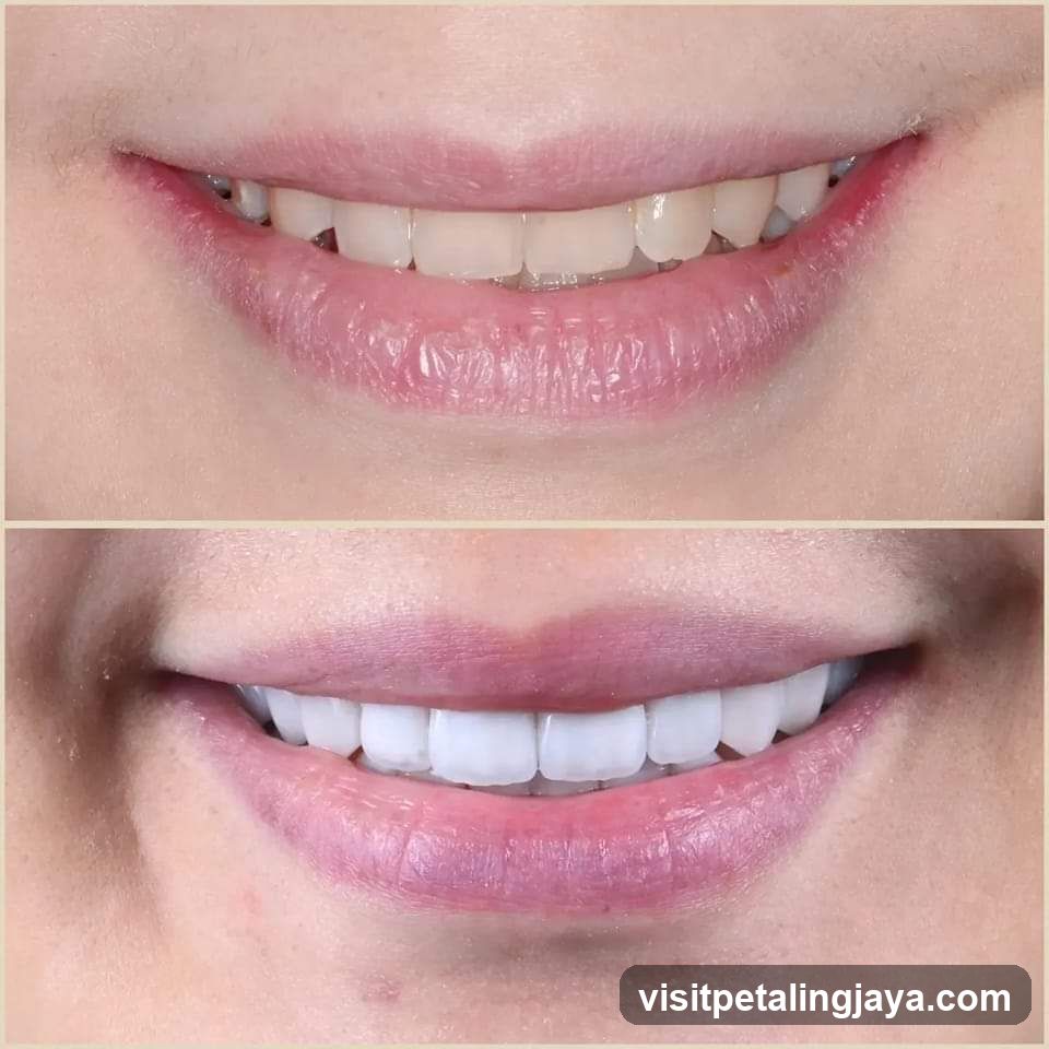 Smile Transformation