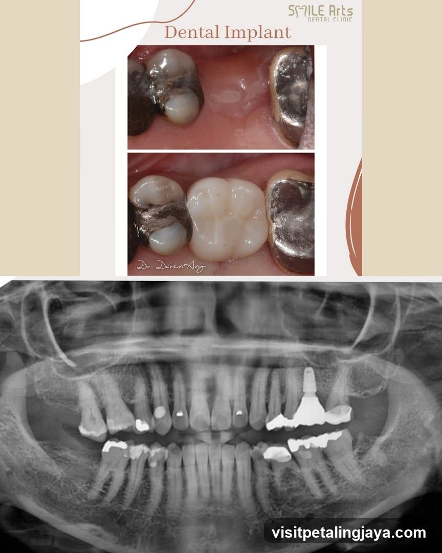 Dental Implant Case Study