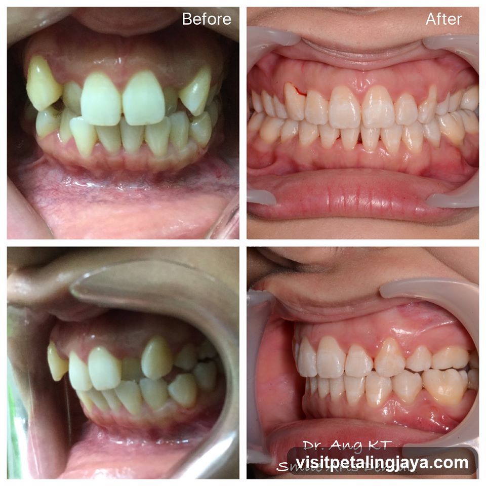 Dental Treatment Before and After Comparison