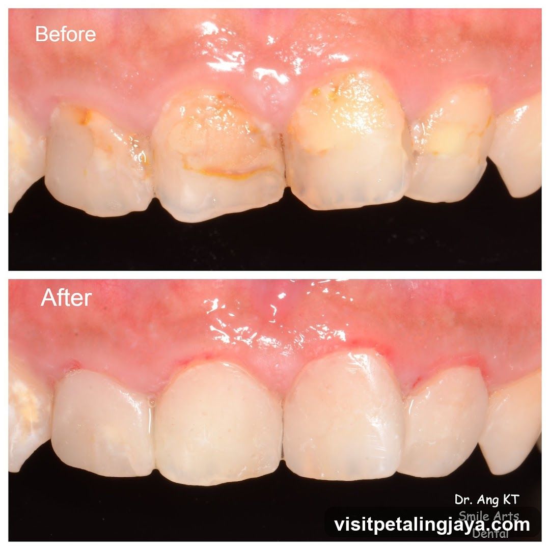 Before and After Dental Treatment