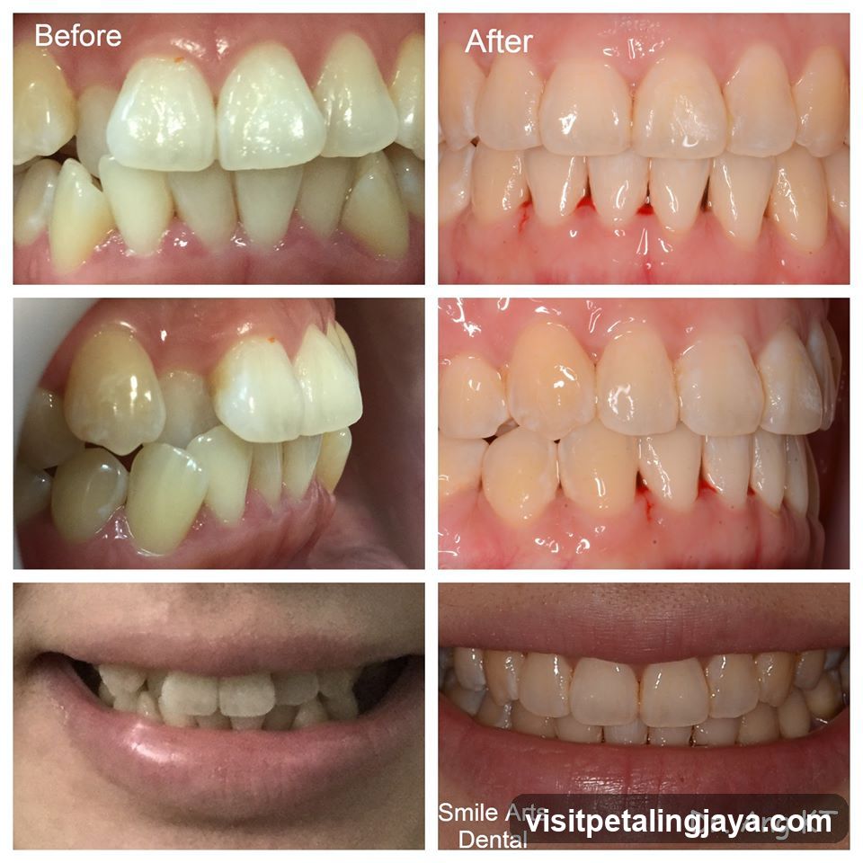 Dental Transformation Before and After