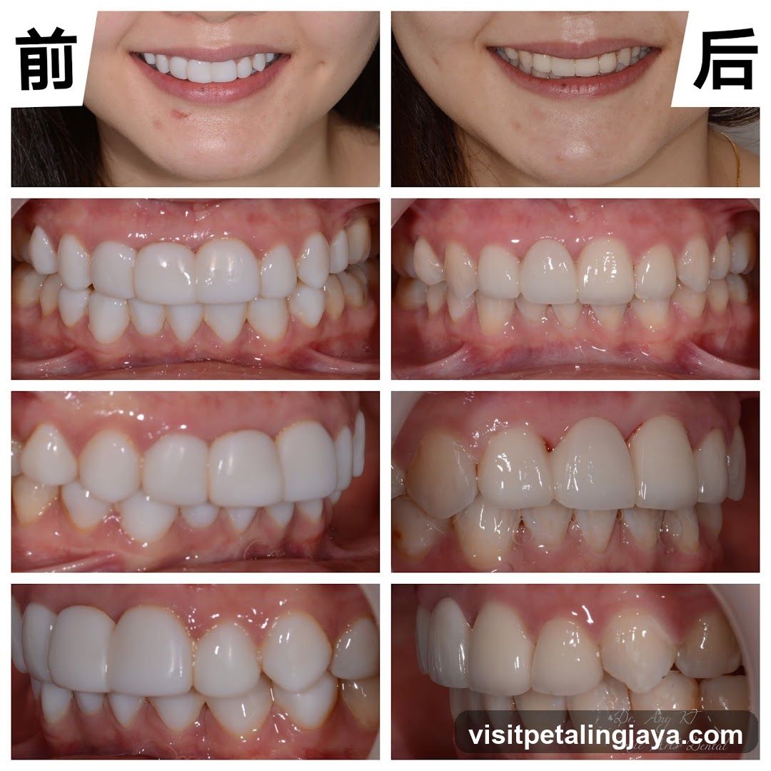 Before and After Dental Treatment Comparison