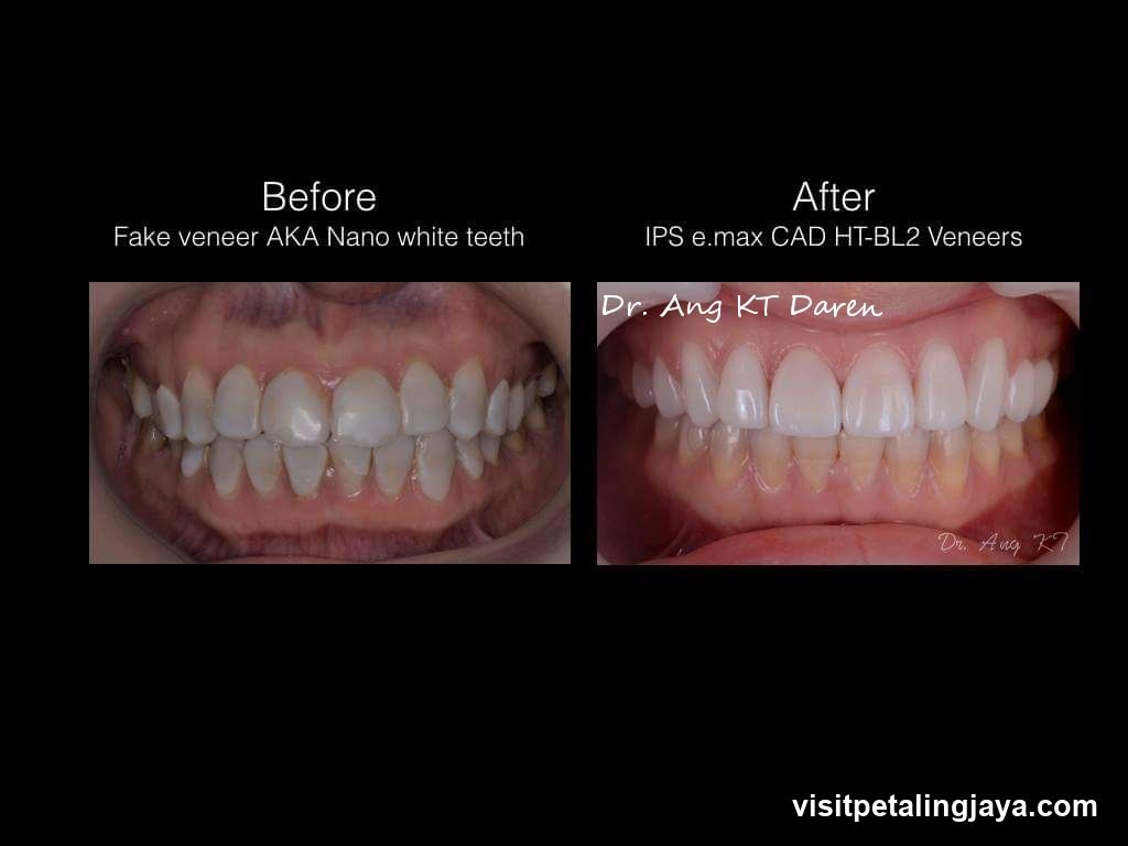 Before and After Dental Veneers Comparison