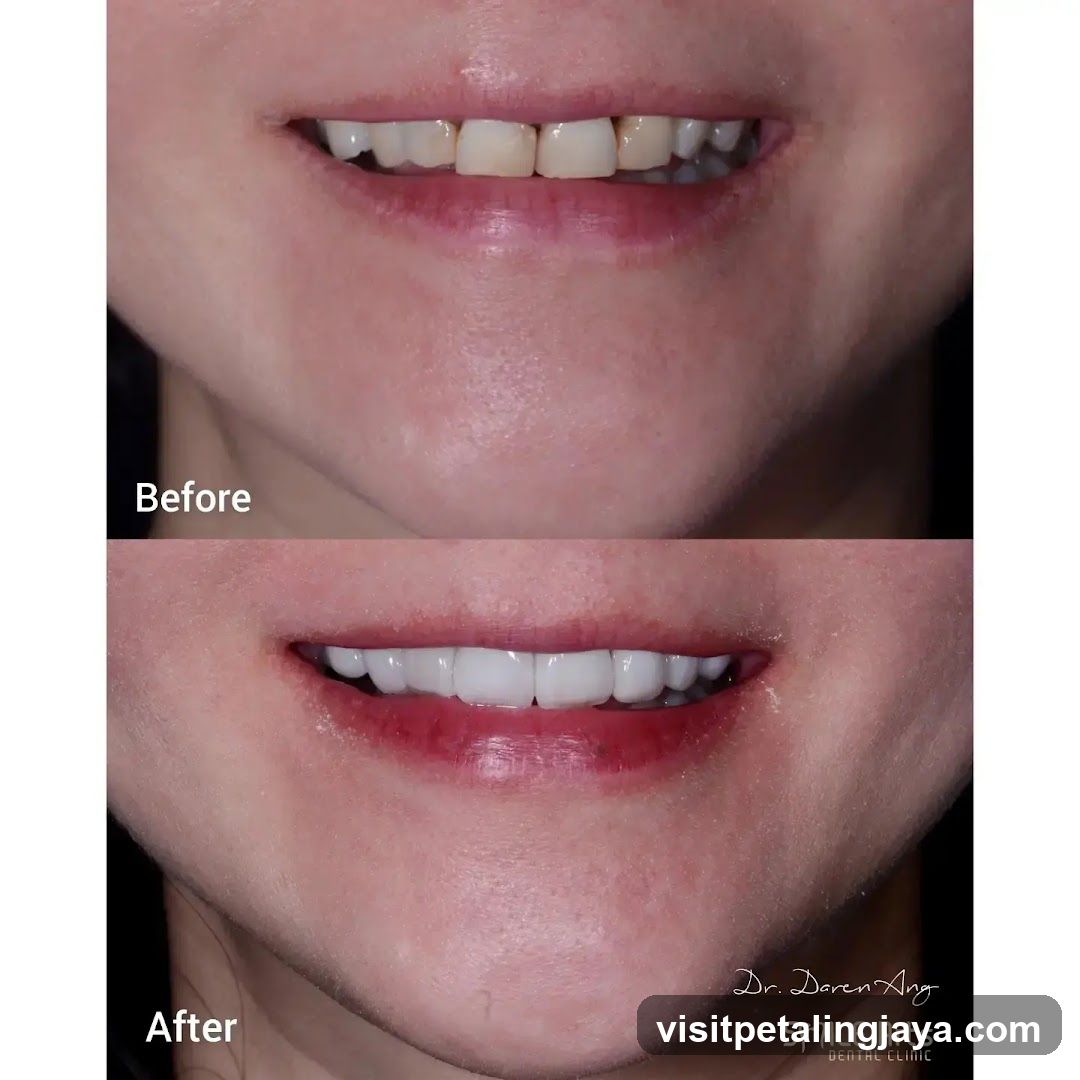 Before and After Dental Smile Transformation