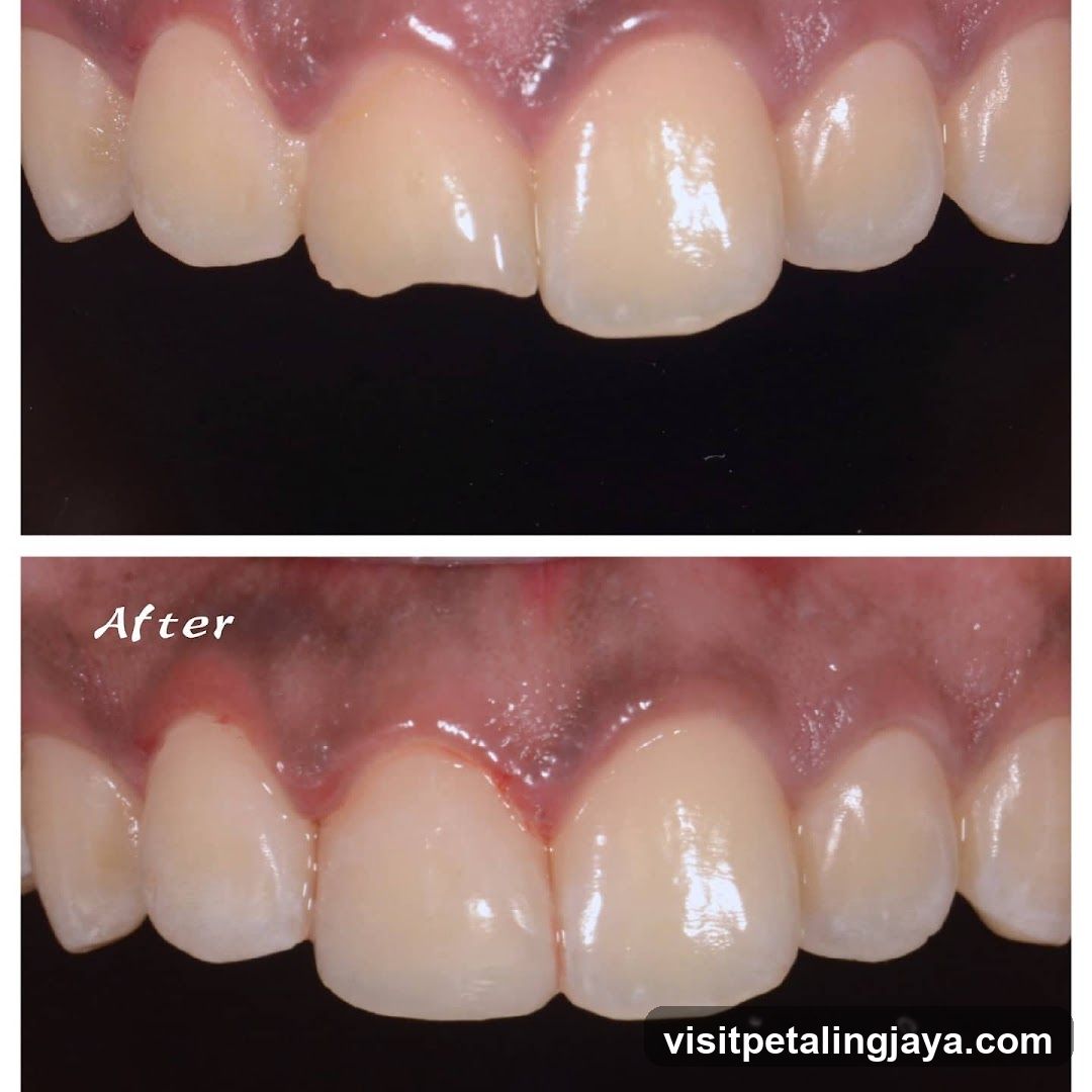 Dental Restoration Comparison