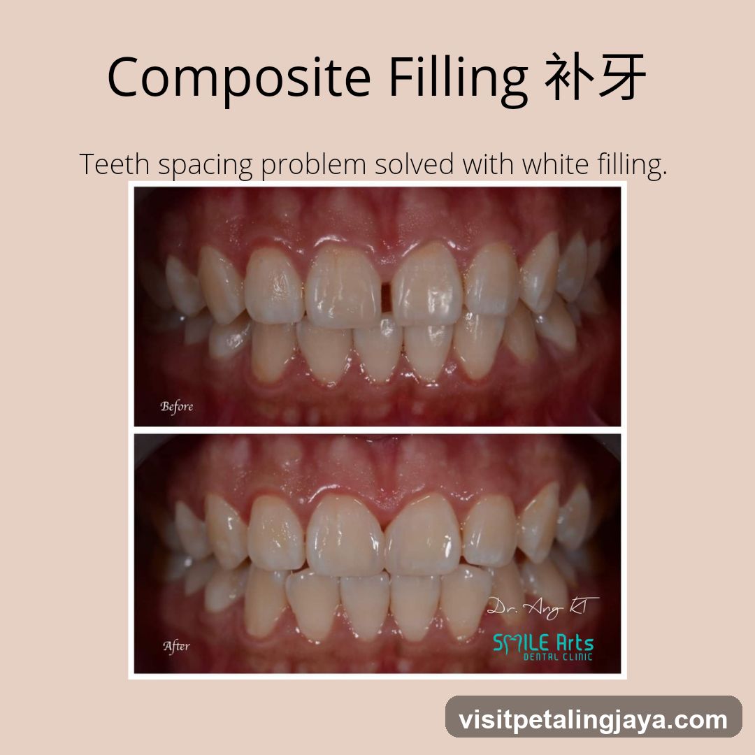 Composite Filling 补牙