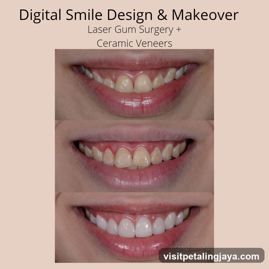 Digital Smile Design & Makeover