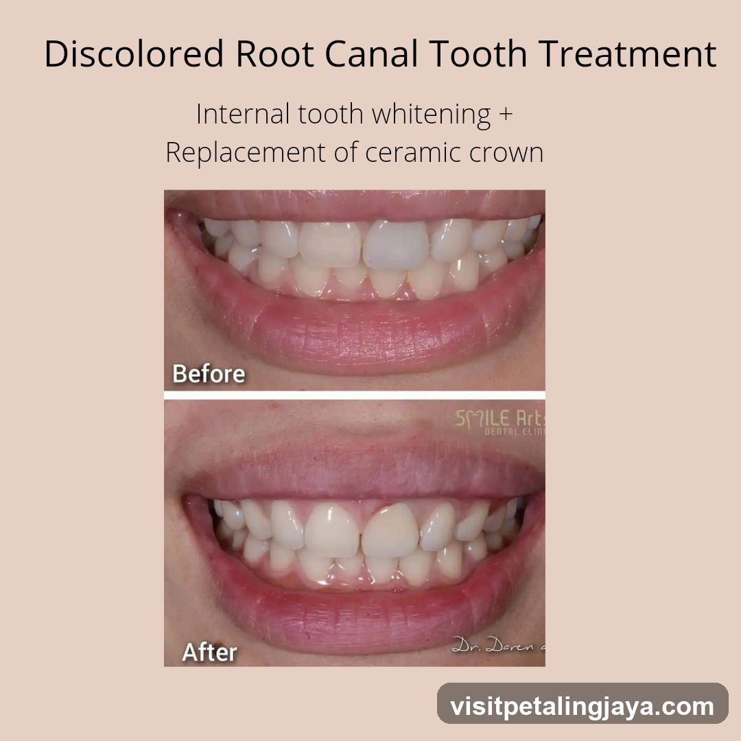 Discolored Root Canal Tooth Treatment