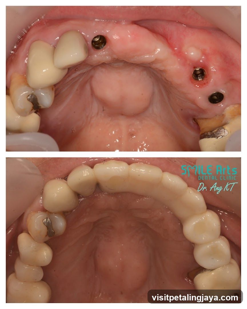 Dental Implant and Prosthesis Case