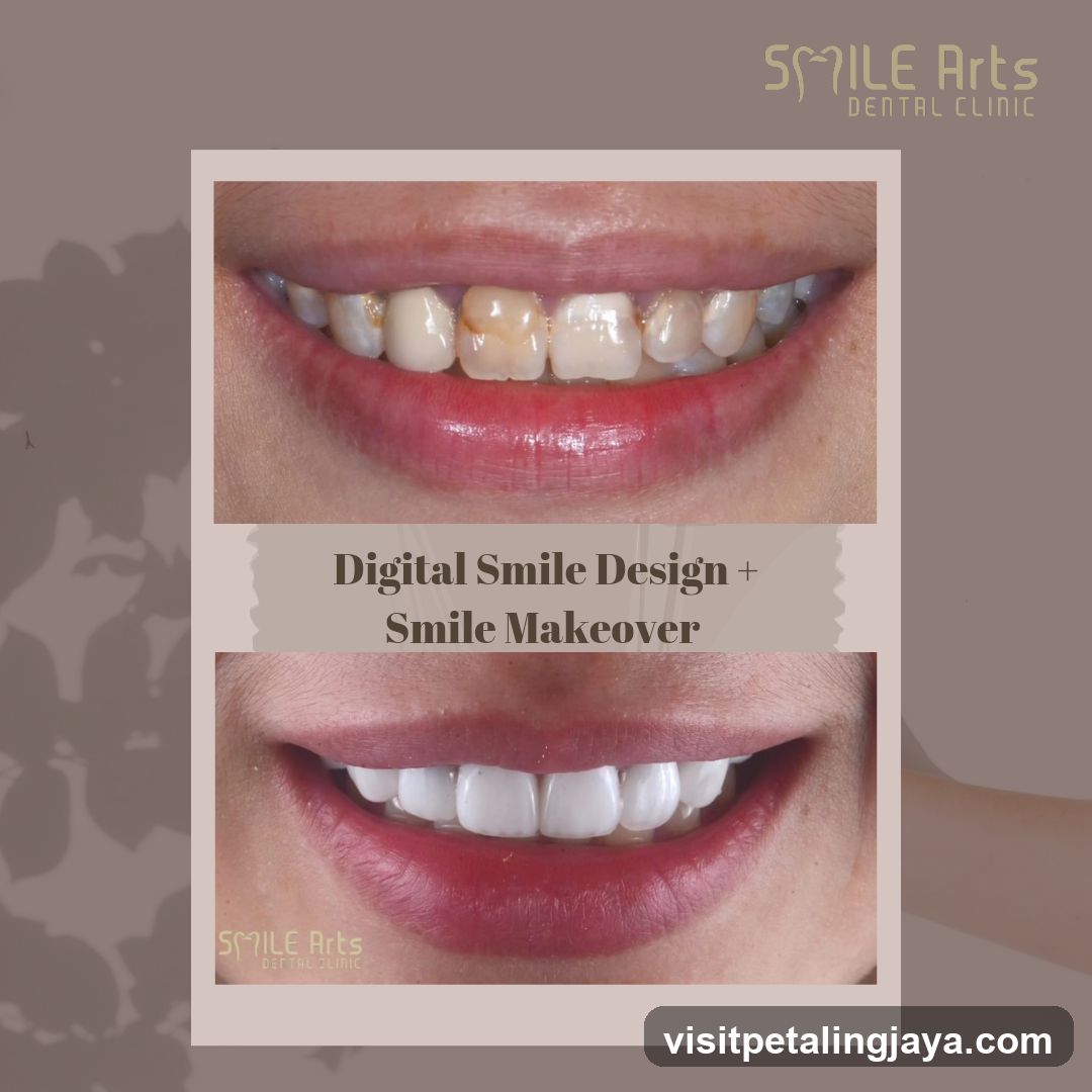 Digital Smile Design + Smile Makeover