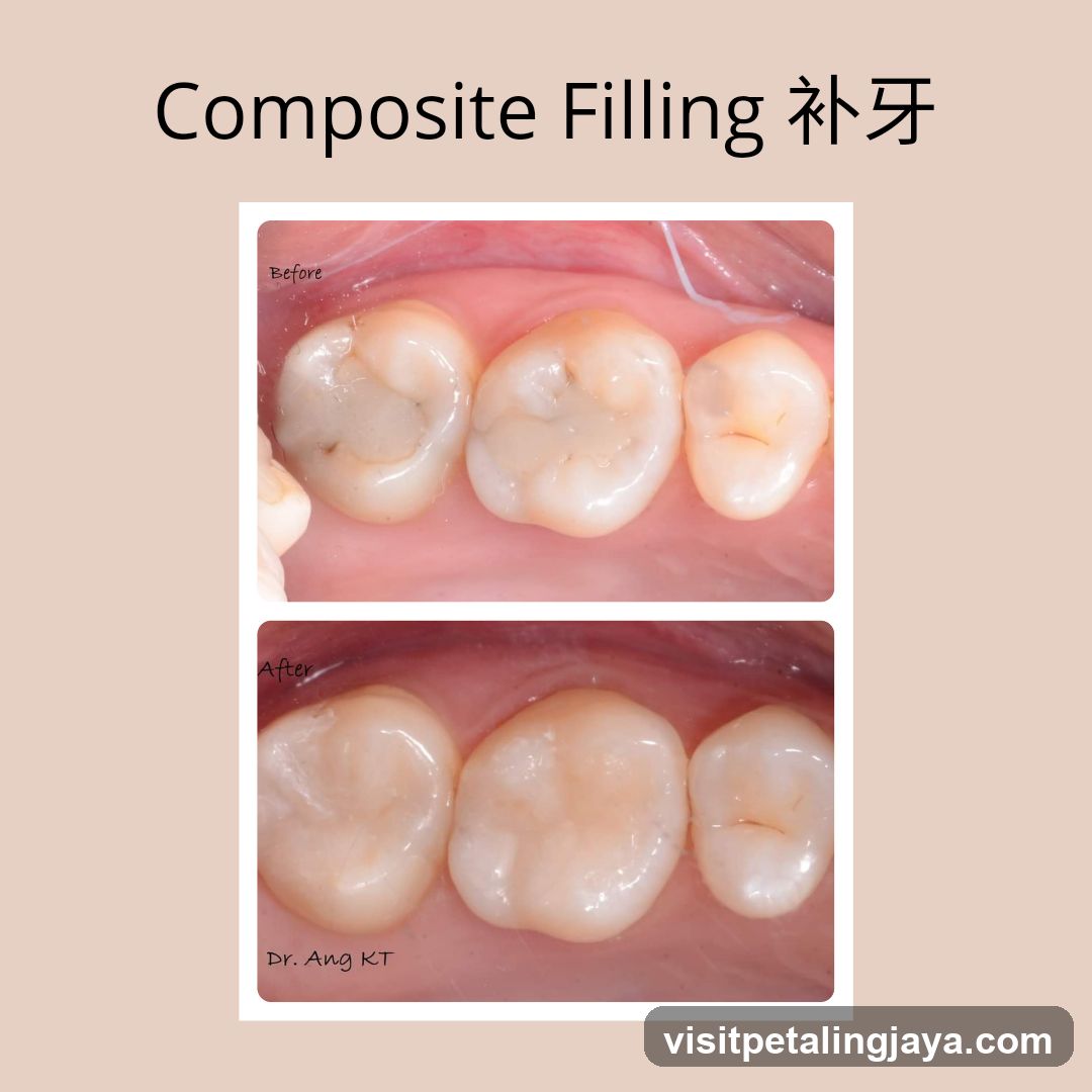 Composite Filling 补牙